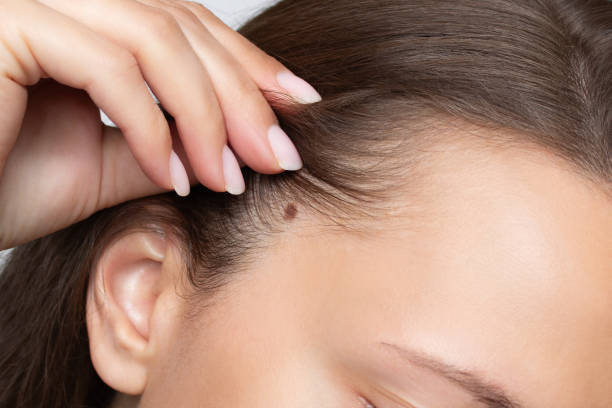 Does Mole Removal Work for Long-Standing Skin Moles