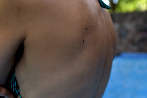 Does Skin Tag Removal Leave Any Scars Behind