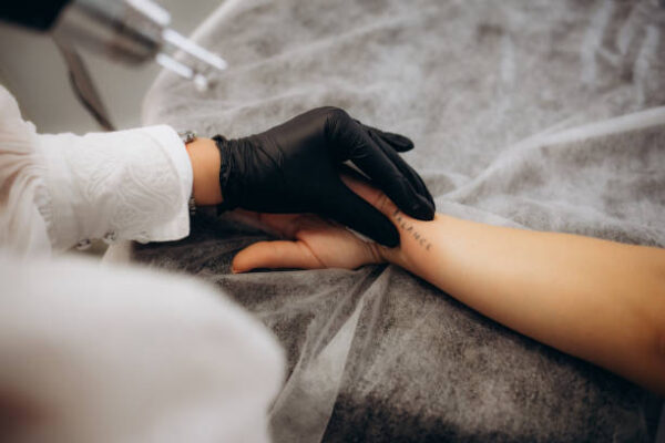 Does Tattoo Removal Work on Dark Skin Tones