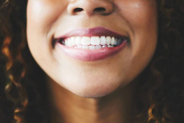 Does Teeth Whitening Really Brighten Teeth