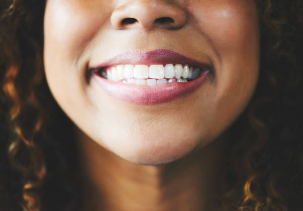 Does Teeth Whitening Really Brighten Teeth
