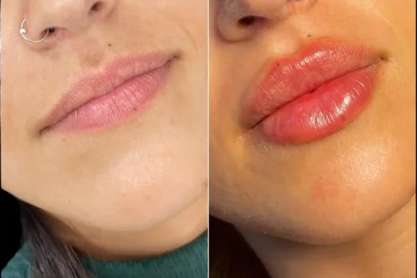 dermal fillers