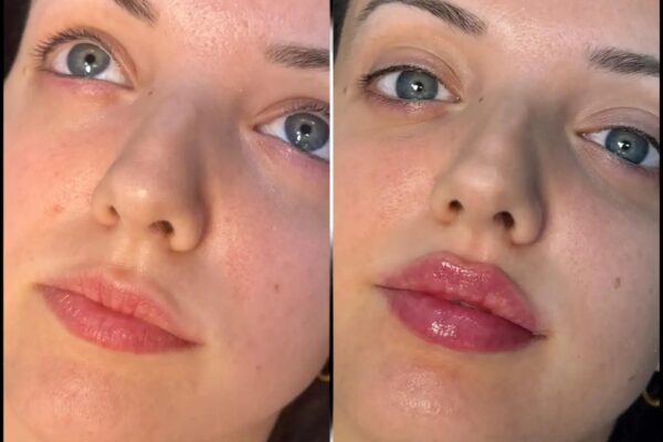 fillers
