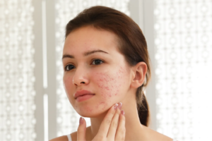 Acne Treatment Abu Dhabi