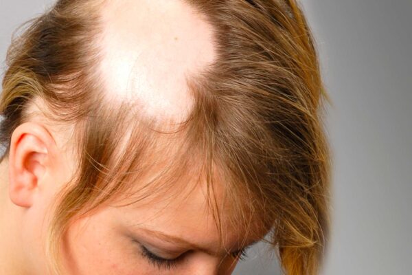 Alopecia Areata Treatment in Abu Dhabi