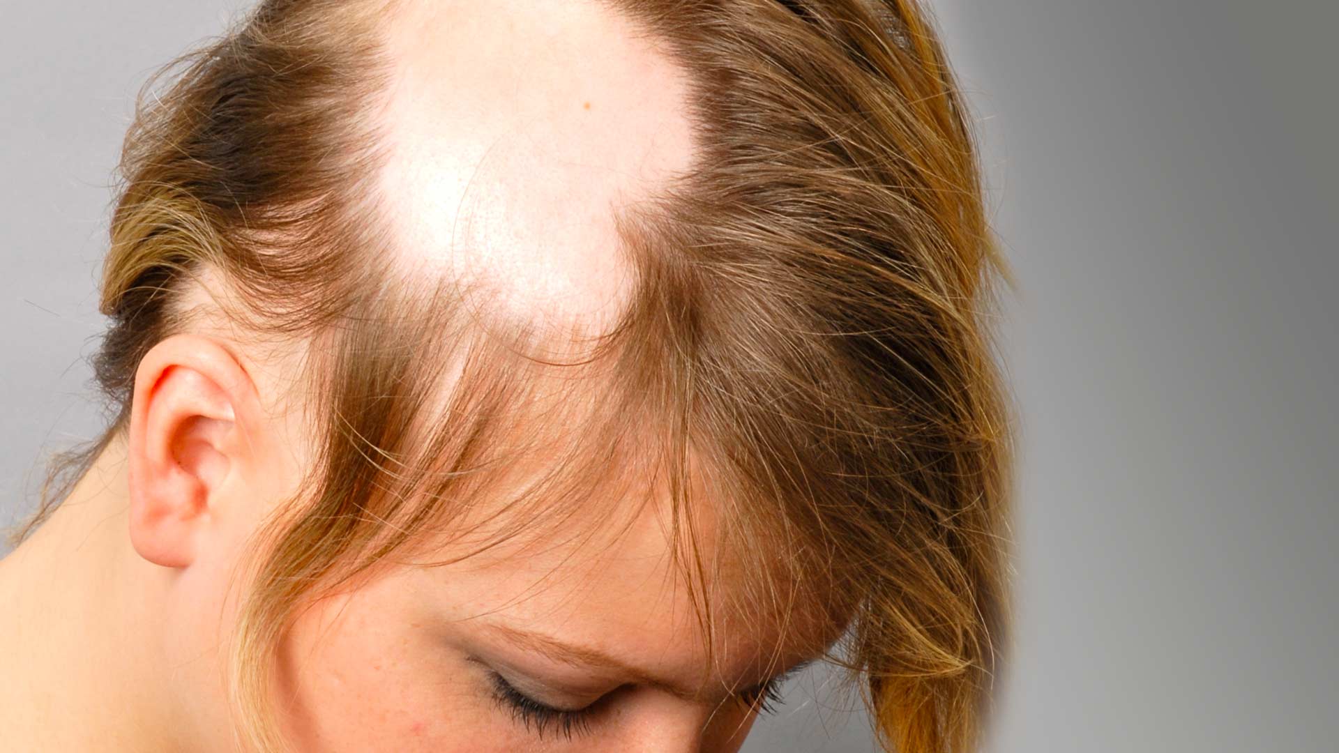 Alopecia Areata Treatment in Abu Dhabi
