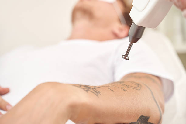 How Does Laser Tattoo Removal Work on Darker Skin Tones Safely