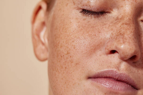How Does Melasma Treatment Support Smooth Glowing Skin