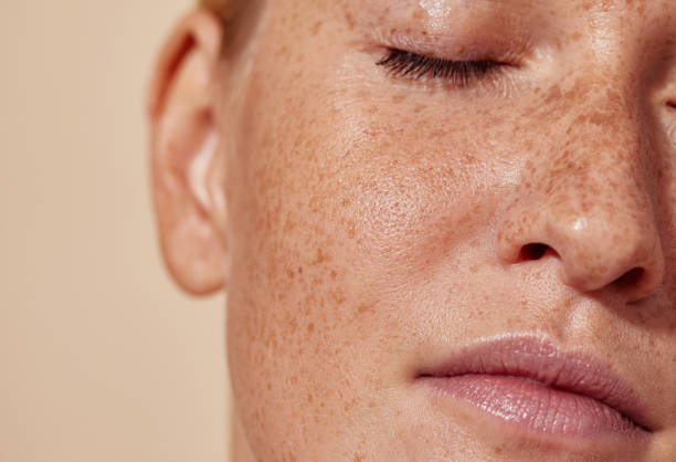 How Does Melasma Treatment Support Smooth Glowing Skin
