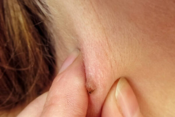 How Effective Is Wart Removal for Large and Deep Warts