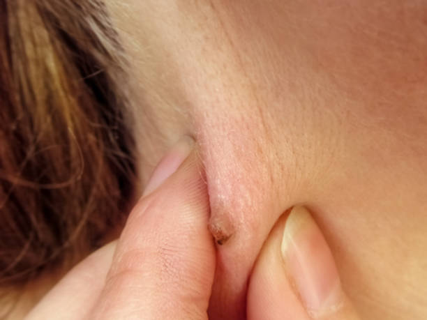 How Effective Is Wart Removal for Large and Deep Warts