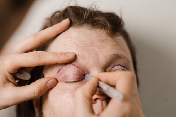 Eyelid Surgery in Abu Dhabi
