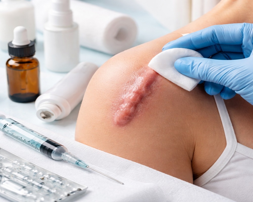 Keloid Treatment in Abu Dhabi