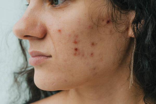 How Long Should You Stay On Acne Treatment For Results Safely