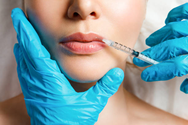 How Russian Lip Fillers Can Transform Lip Appearance