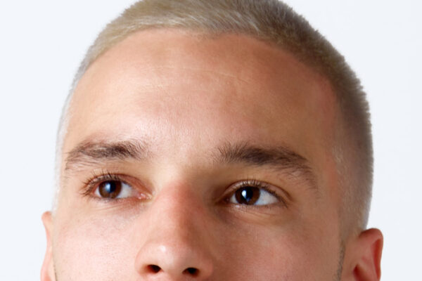 Brow Lift Surgery in Abu Dhabi