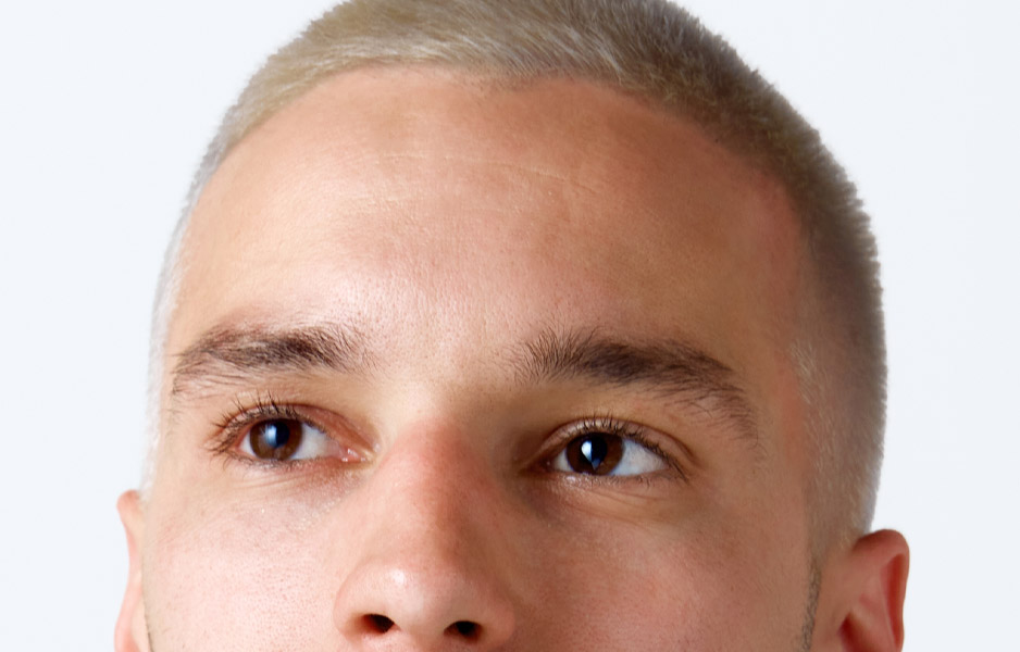 Brow Lift Surgery in Abu Dhabi