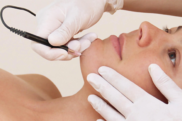Electrolysis Laser Hair Removal in Abu Dhabi