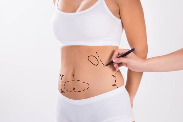 Is Liposuction Effective For Reducing Love Handles Quickly
