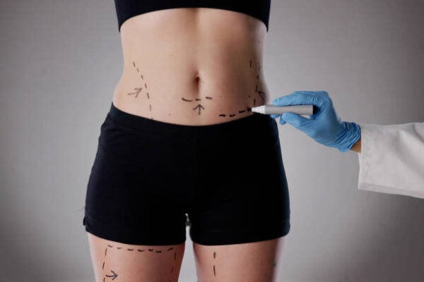 Is Liposuction Recommended for Body Fat Reduction