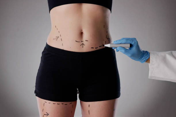 Is Liposuction Recommended for Body Fat Reduction