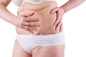 Mini Abdominoplasty in Abu Dhabi