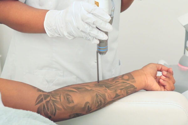 Picosure Tattoo Removal in Abu Dhabi