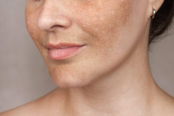 Pigmentation Treatment in Abu Dhabi