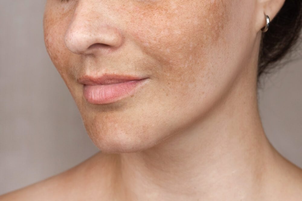 Pigmentation Treatment in Abu Dhabi
