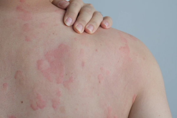 Skin Diseases Treatment in Abu Dhabi