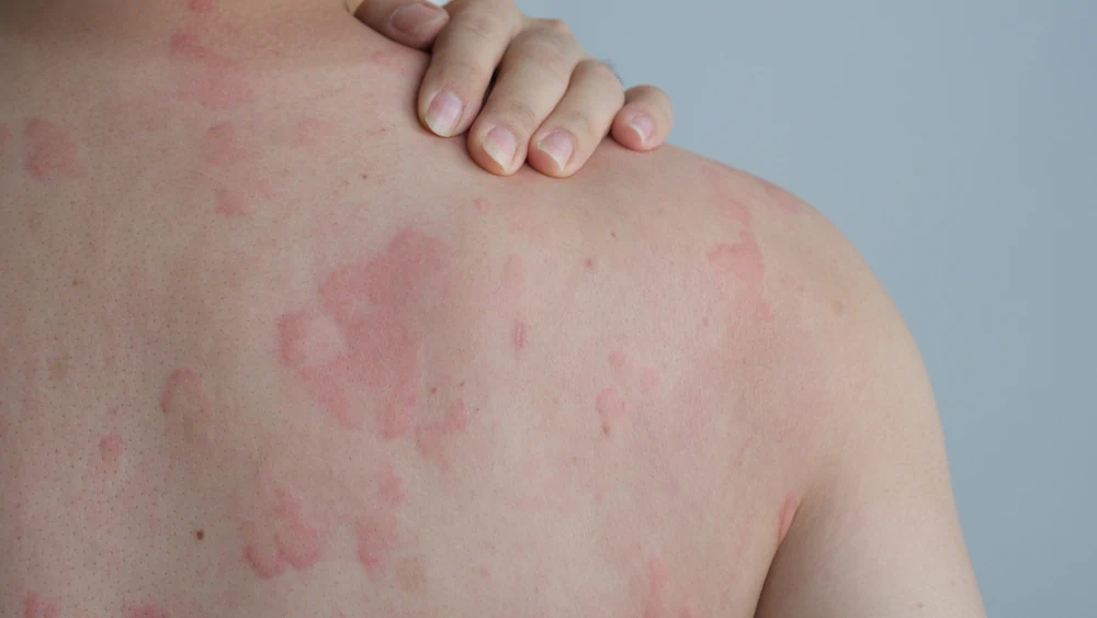 Skin Diseases Treatment in Abu Dhabi