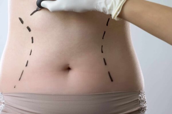 Tummy Tuck in Abu Dhabi
