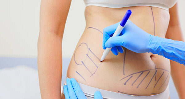 Is Tummy Tuck Worth It for Long Term Body Contouring