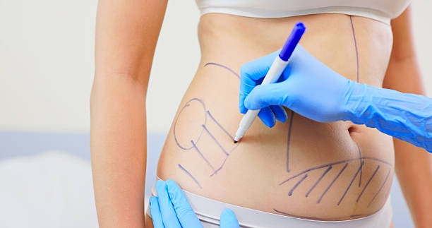 Is Tummy Tuck Worth It for Long Term Body Contouring