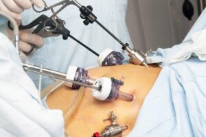 laparoscopic in Islamabad