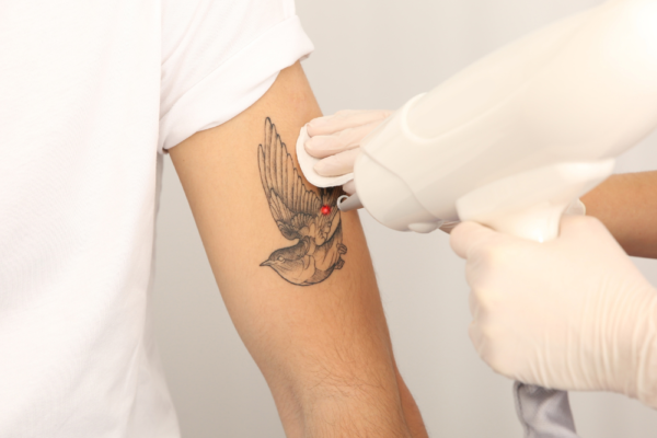 Remove Unwanted Ink with Laser Tattoo Removal
