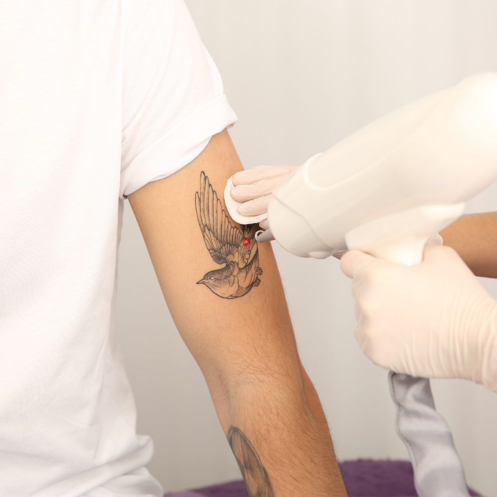 Remove Unwanted Ink with Laser Tattoo Removal
