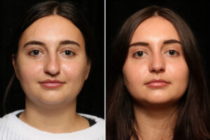 rhinoplasty in islamabad