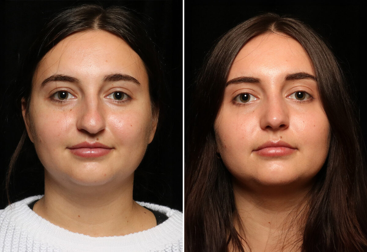rhinoplasty in islamabad