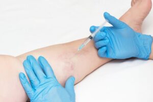 Say Goodbye to Spider Veins with Sclerotherapy