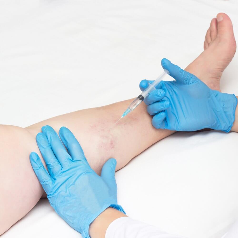 Say Goodbye to Spider Veins with Sclerotherapy