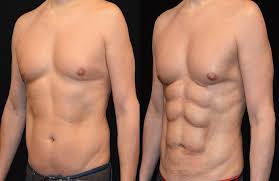 Sixpack Liposuction in Dubai