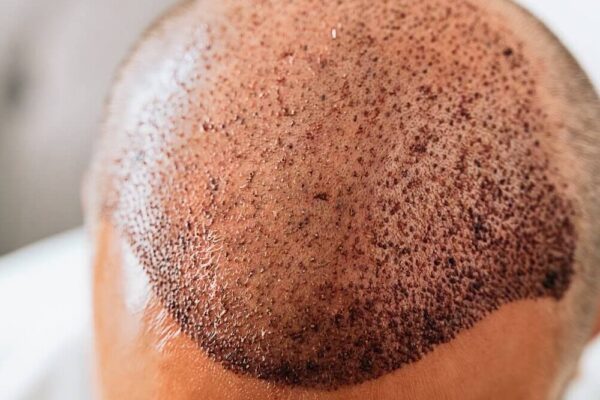 The Complete Guide to Hair Transplant What You Need to Know