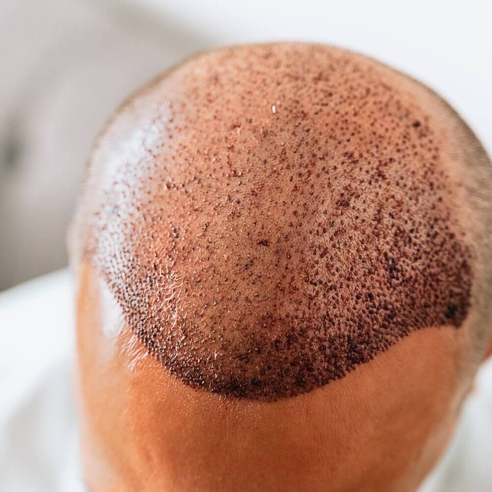 The Complete Guide to Hair Transplant What You Need to Know