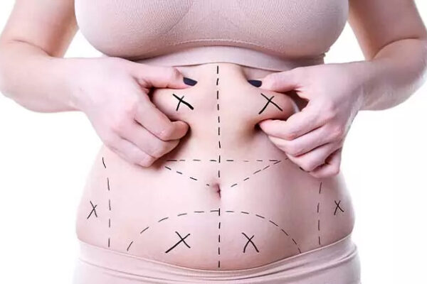 Tummy Tuck in Islamabad
