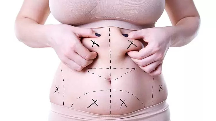 Tummy Tuck in Islamabad