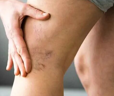 Varicose Veins Treatment In Dubai