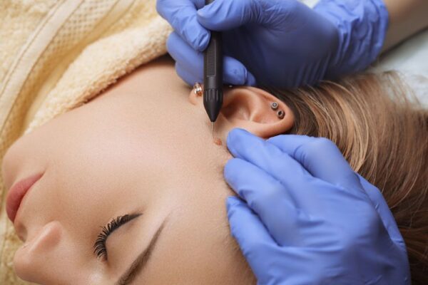 Skin Lesion Removal in Abu Dhabi
