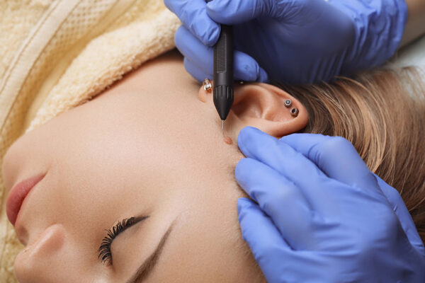 Warts Removal Treatment in Abu Dhabi