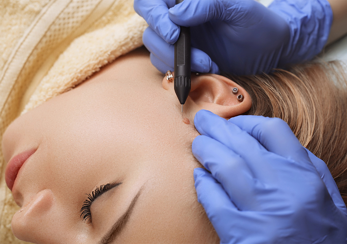 Warts Removal Treatment in Abu Dhabi
